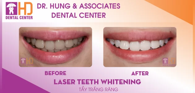 Thẩm mỹ & phục hình công nghệ Tẩy trắng răng hiện đại