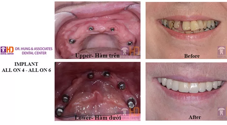 Trồng răng implant toàn hàm loại nào tốt nhất? implant all on 4 6