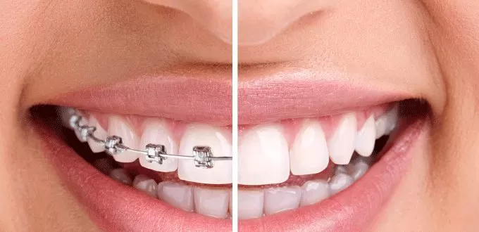 5 điều chưa biết về niềng răng Invisalign không mắc cài Niềng răng không mắc cài là gì?
