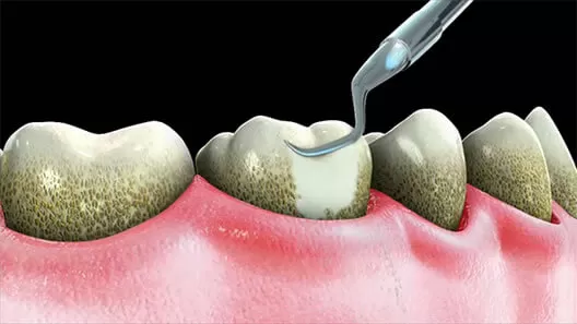 Hỗ trợ điều trị bệnh nha chu Cạo vôi răng được coi là yếu tố quan trọng hàng đầu