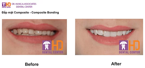 Mặt dán Composite composite dr hung