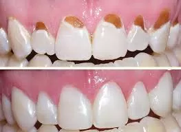 Mặt dán Composite dr.hung-composite-bonding