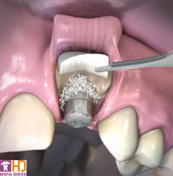 Kỹ thuật hỗ trợ cấy ghép Implant Kỹ thuật hỗ trợ cấy ghép Implant