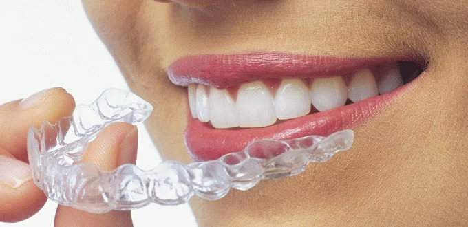 Niềng răng không mắc cài Invisalign Niềng răng không mắc cài Invisalign tại Kubet Worldwide