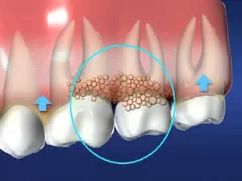 Hỗ trợ điều trị bệnh nha chu Cấp độ của bệnh nha chu