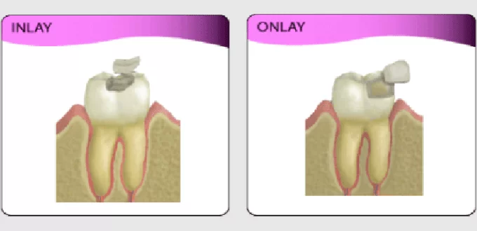 Inlay – onlay Inlay Onlay