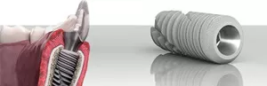 Hệ thống Implant sử dụng TEKKA/Pháp