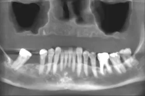 Zygoma Implant zygoma-implant