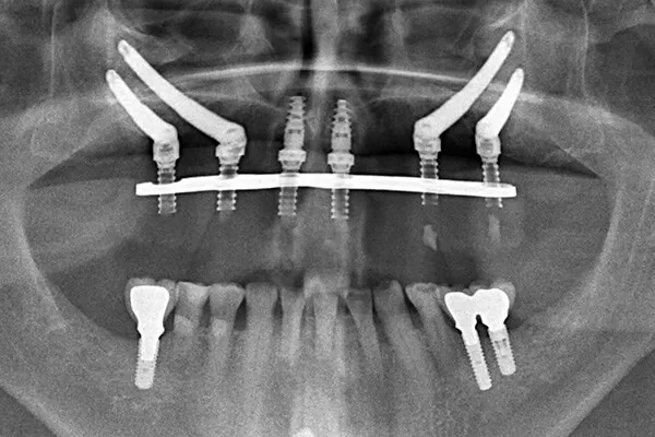 Zygoma Implant Hình X-Quang của một ca cắm ghép Zygoma Implant