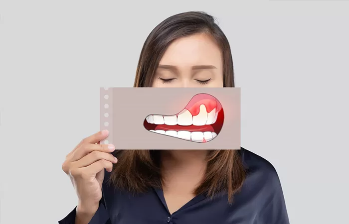 Điều trị bệnh nha chu benh nha chu