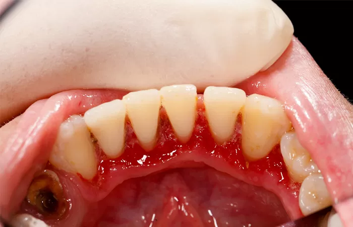 Điều trị bệnh nha chu benh nha chu