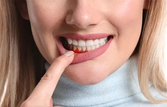 Điều trị bệnh nha chu benh nha chu