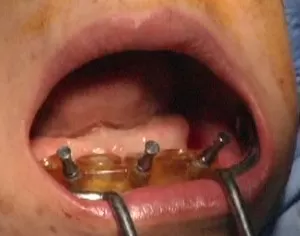 Một ca lâm sàng All on 4 cam-implant-theo-ke-hoach-dieu-tri