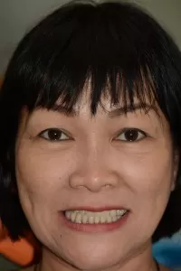 Một ca lâm sàng All on 4 ham-co-dinh-vinh-vien