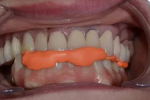 Một ca lâm sàng All on 4 hinh-KHOP-CAN-dua-theo-ham-tam