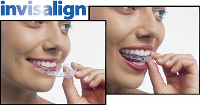 Những câu hỏi về Invisalign thường gặp nhất nieng-rang-invisalign-co-dau-khong-3