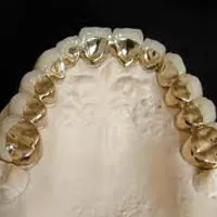 Các loại răng sứ rang-su-kim-loai-quy