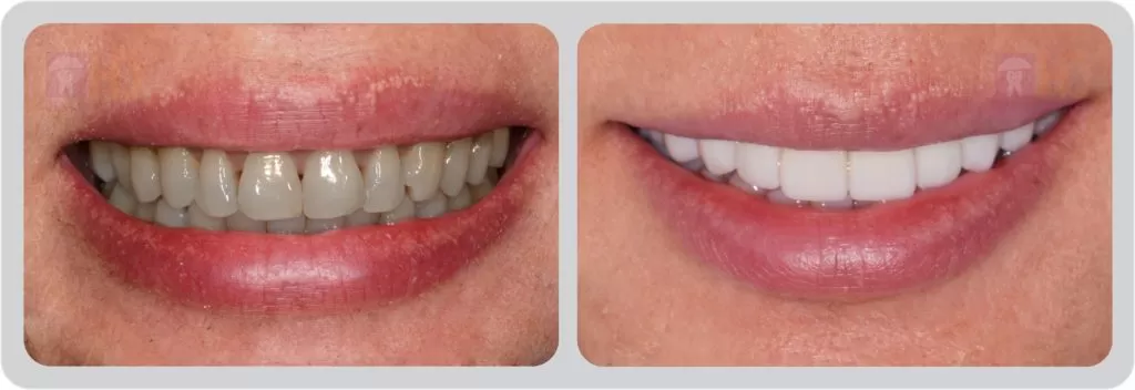 XU HƯỚNG MỚI: LÀM RĂNG ĐẸP VỚI VENEER SIÊU MỎNG Hình ảnh trước và sau khi làm veneer sứ siêu mỏng tại TT Nha Khoa Dr Hùng & cộng sự.