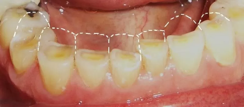 NGHIẾN RĂNG – LIỆU CÓ CẦN ĐIỀU TRỊ? Bệnh nhân bị mòn răng nghiêm trọng do nghiến răng lúc ngủ