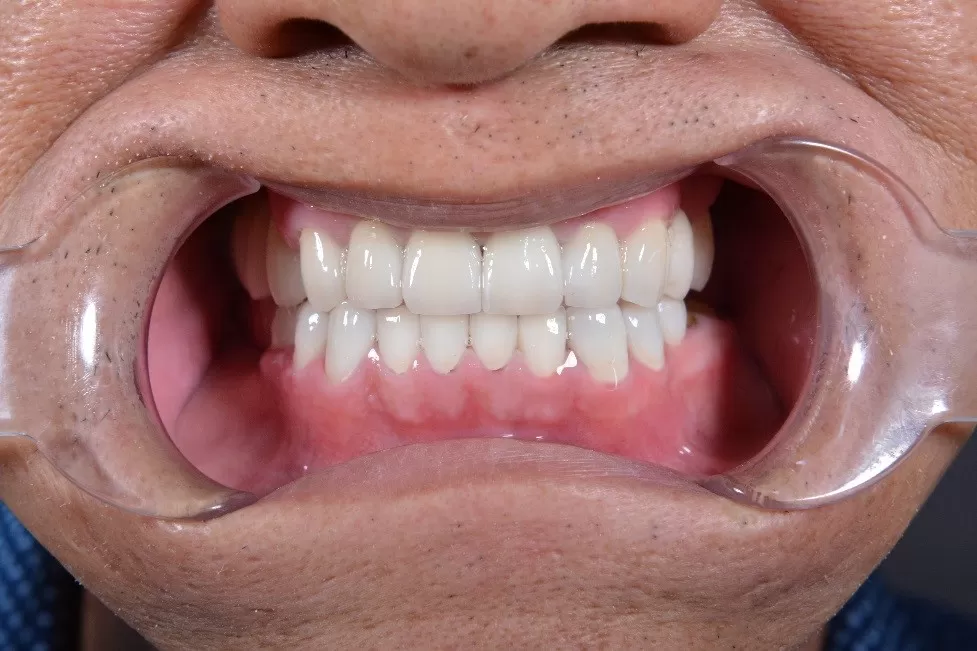 NGHIẾN RĂNG – LIỆU CÓ CẦN ĐIỀU TRỊ? Bệnh nhân được điều trị bằng phương pháp phục hồi toàn hàm bằng mão sứ tại Kubet Worldwide