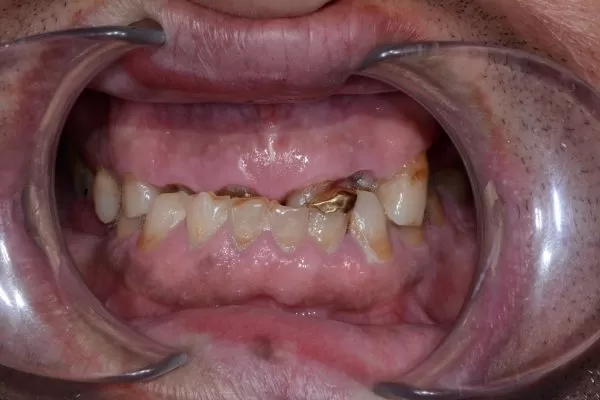 NGHIẾN RĂNG – LIỆU CÓ CẦN ĐIỀU TRỊ? Bệnh nhân nam 53 tuổi bị mòn răng hàm trên do nghiến răng