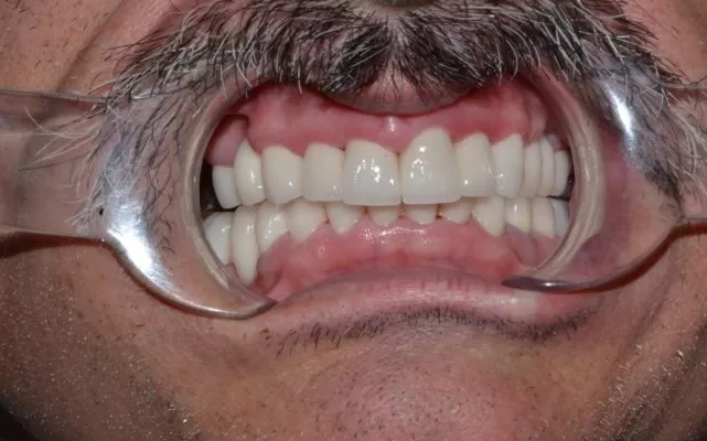 NGHIẾN RĂNG – LIỆU CÓ CẦN ĐIỀU TRỊ? Bệnh nhân được điều trị phục hồi toàn hàm tại Kubet worldwide
