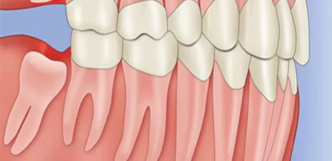 Nhổ răng khôn mọc lệch, mọc ngầm - Tổng hợp những điều cần biết nho rang khon