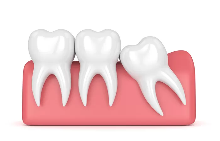 Nhổ răng khôn mọc lệch, mọc ngầm - Tổng hợp những điều cần biết nho rang khon