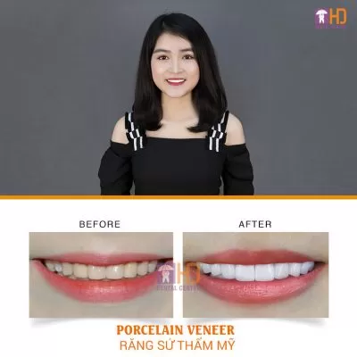 CÓ NÊN LÀM RĂNG SỨ THẨM MỸ? Khách hàng tin hơn khi cười với răng sứ thẩm mỹ tại trung tâm nha khoa Dr Hùng