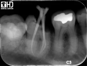 ĐIỀU TRỊ TỦY RĂNG TRONG NHỮNG CA KHÓ CHUA TUY RANG COI LON HAM DUOI