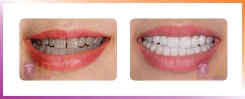 Veneer sứ là gì? veneer