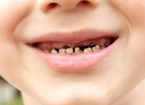 NHỮNG SAI LẦM CHA MẸ GẶP PHẢI TRONG CHĂM SÓC RĂNG TRẺ EM Nghĩ rằng sâu răng sữa không gây ảnh hưởng lớn