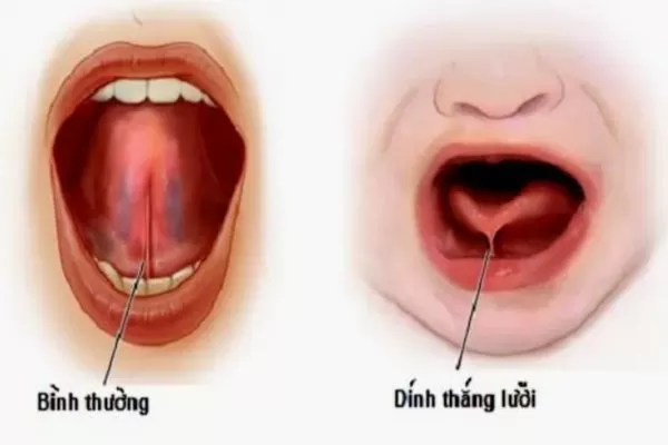 Cắt thắng môi, cắt thắng lưỡi không đau tại Kubet Worldwide hinh anh thang luoi binh thuong