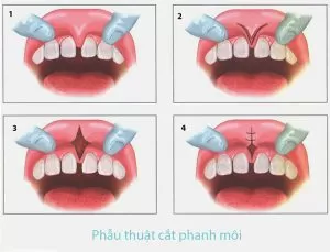 Cắt thắng môi, cắt thắng lưỡi không đau tại Kubet Worldwide cat thang moi