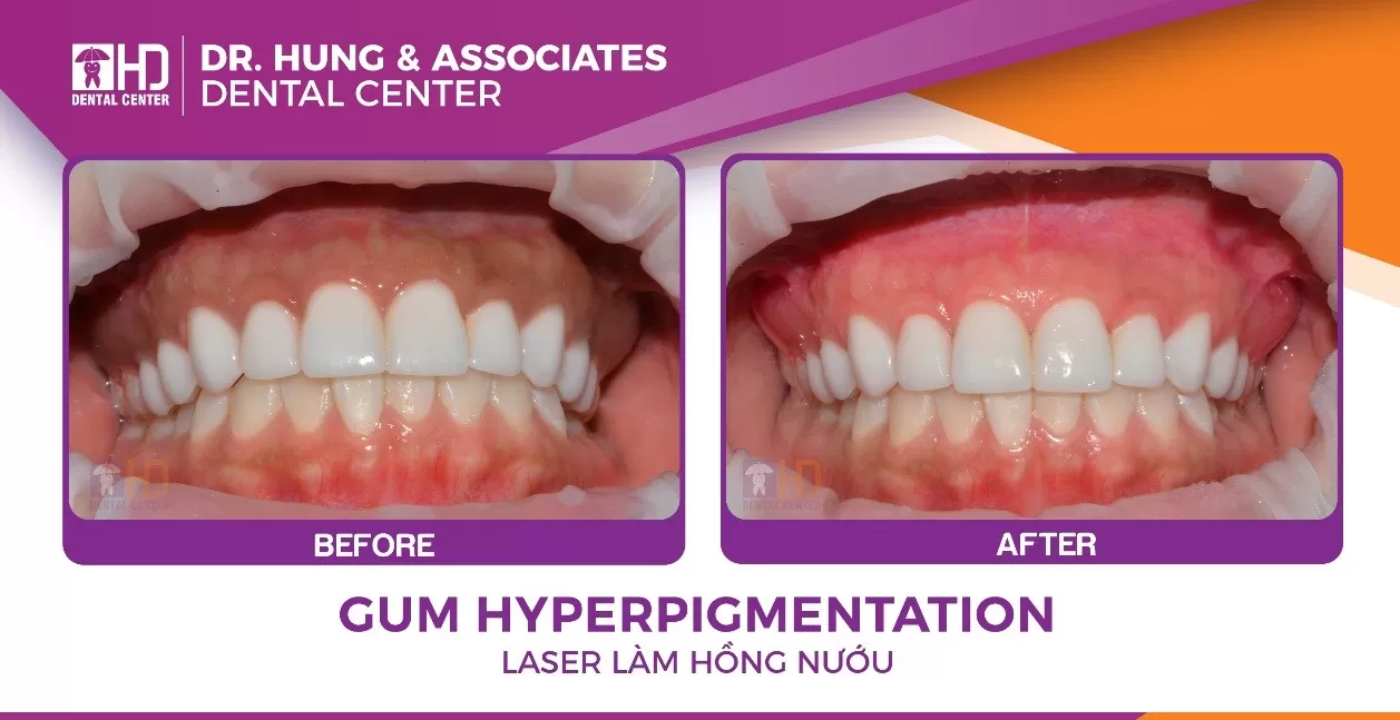 LÀM HỒNG NƯỚU RĂNG BẰNG LASER LIGHTWALKER Kết quả trước sau khi làm hồng nướu với máy Laser LightWaker AT