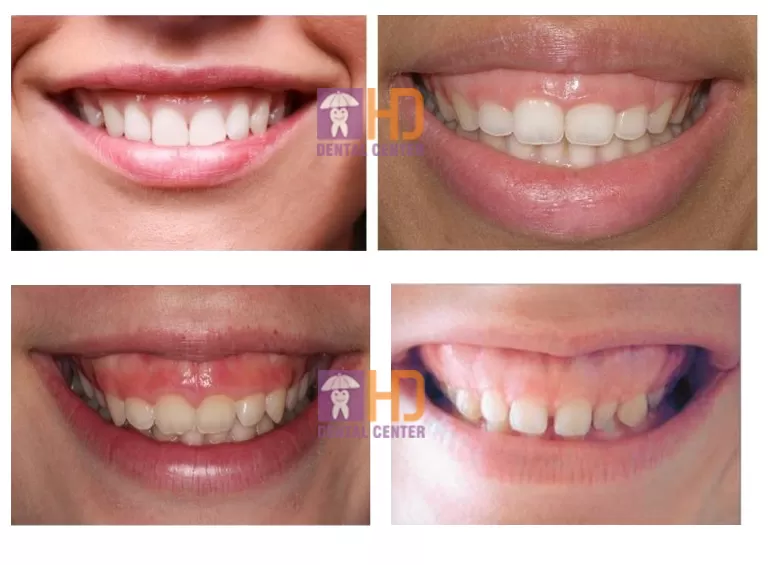 CƯỜI HỞ LỢI VÀ NHỮNG SỰ THẬT LIÊN QUAN TƯỚNG SỐ cac muc do cuoi ho loi tai nha khoa dr hung