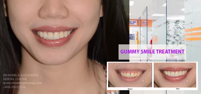 CƯỜI HỞ LỢI VÀ NHỮNG SỰ THẬT LIÊN QUAN TƯỚNG SỐ Khách hàng điều trị cười hở lợi kết hợp với Veneer sứ siêu mỏng tại TT nha khoa Dr Hùng