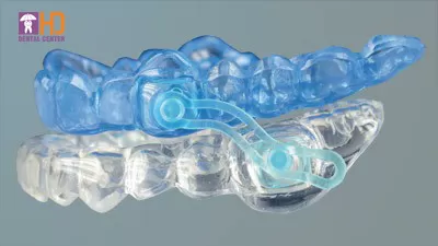 LÀM THẾ NÀO ĐỂ KHÔNG NGÁY KHI NGỦ ? máng chống ngáy