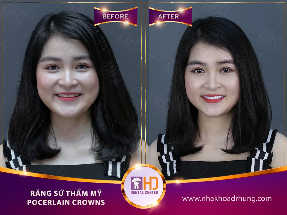 SO SÁNH ƯU NHƯỢC ĐIỂM CÁC LOẠI RĂNG SỨ Hình ảnh khách hàng khi thực hiện Răng sứ Nacera Pearl/ Răng sứ Ngọc Trai