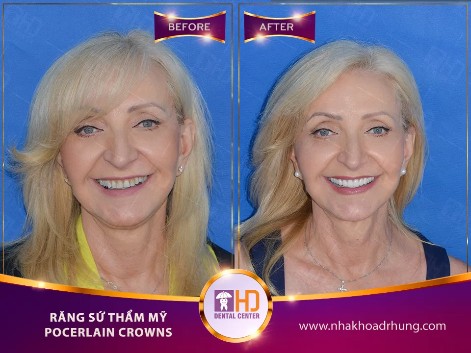 SO SÁNH ƯU NHƯỢC ĐIỂM CÁC LOẠI RĂNG SỨ Hình ảnh khách hàng khi thực hiện Răng sứ Full Zirconia