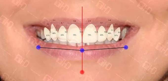 NỤ CƯỜI ĐẸP TỰ NHIÊN VỚI CÔNG NGHỆ NATURAL SMILE DESIGN 4