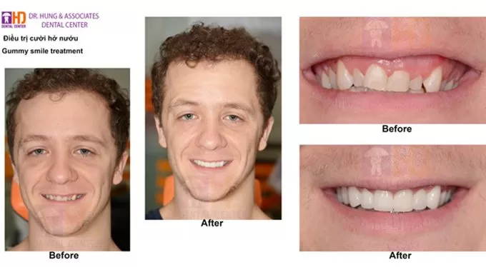 CƯỜI HỞ LỢI VÀ NHỮNG SỰ THẬT LIÊN QUAN TƯỚNG SỐ dieu-tri-cuoi-ho-nuou