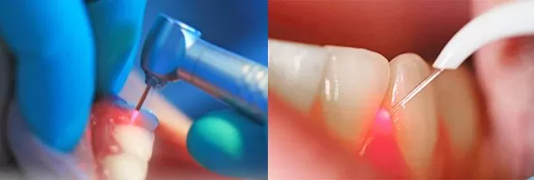 Áp dụng Laser cho điều trị nào? Các ứng dụng của laser nha khoa hiện nay