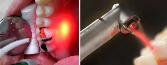 Áp dụng Laser cho điều trị nào? Trám răng: Laser Er:YAG