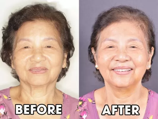 ĐI ĐÂU TRỒNG RĂNG KHI BỊ MẤT RĂNG & TIÊU XƯƠNG HÀM? 3