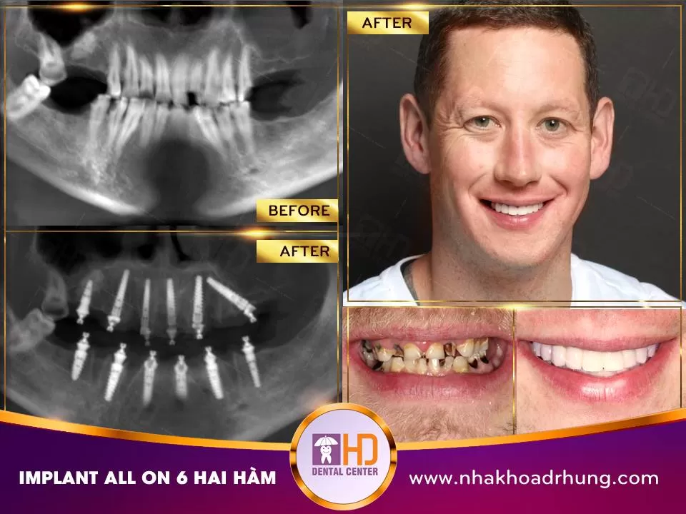 BOM TẤN THÁNG 11 – LÀM 1 ĐƯỢC 2: CÀNG LÀM CÀNG ĐẸP implant all on 6 hai hàm