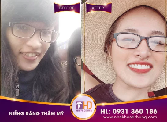 Niềng răng mất bao lâu? Yếu tố nào ảnh hưởng đến thời gian? nieng rang tham my