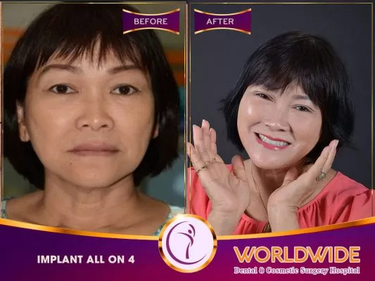Trồng răng implant toàn hàm loại nào tốt nhất? Người mất răng toàn hàm - Chuyên gia chia sẻ giải pháp