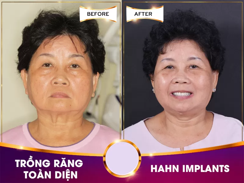 Implant nha khoa nào hiện nay tốt nhất cho giới trẻ thành thị Việt Nam? Cấy ghép Implant tại nha khoa Dr Hùng