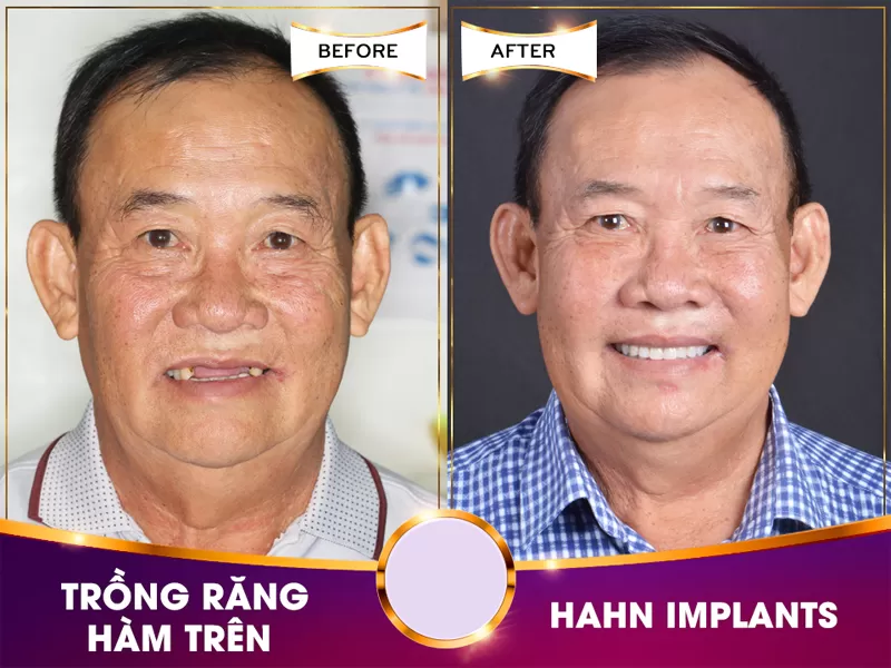 Implant nha khoa nào hiện nay tốt nhất cho giới trẻ thành thị Việt Nam? Khách hàng cấy ghép Implant tại nha khoa Dr Hùng